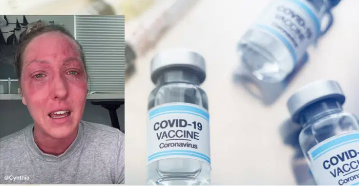 Následek očkování: Ekzém rozlezlý po celém obličeji – po každé dávce horší (video)