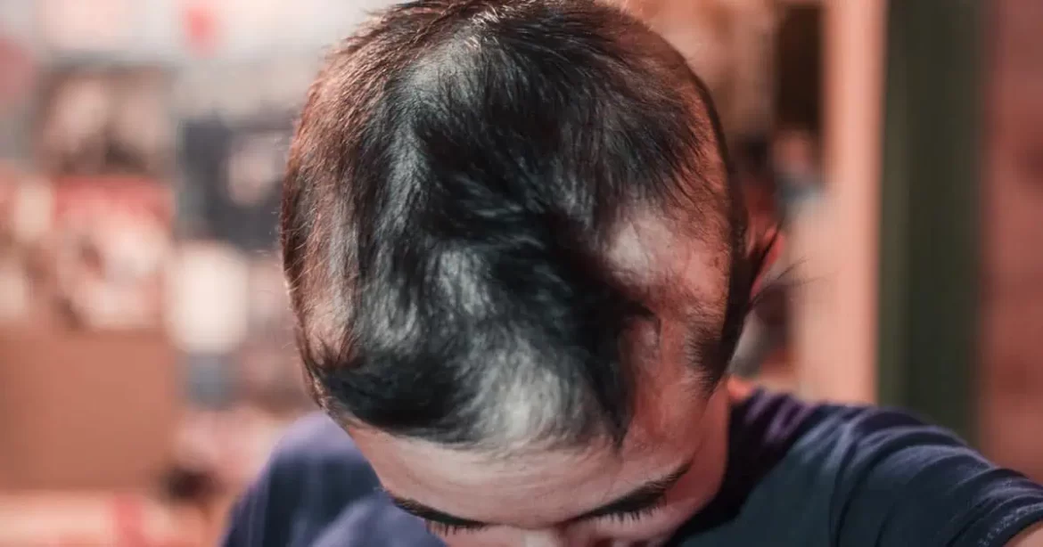 Studie spojuje „vakcíny“ proti Covidu s vypadáváním vlasů5 (7)