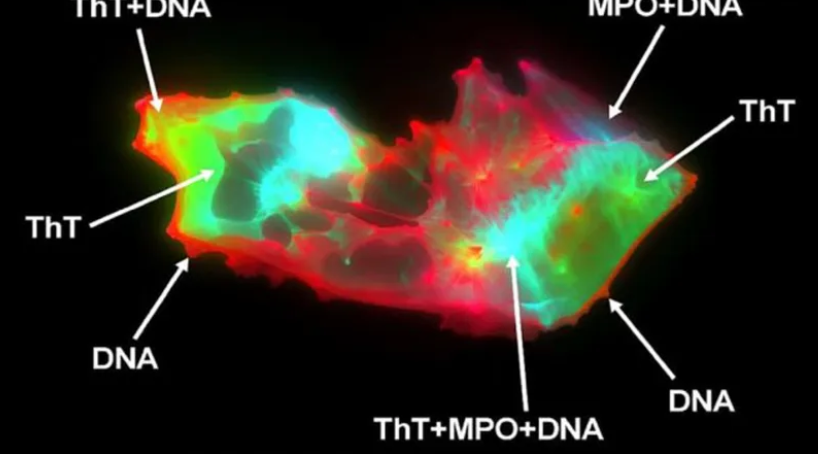 Aktuální studie: Anomální amyloidní mikrosraženiny nalezeny u 100 % očkovaných proti COVID-194.9 (28)
